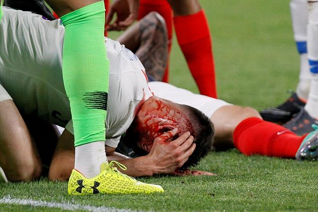 Po srážce hlavami v utkání mezi Francií a USA skončil Američan Matt Miazga s tržnou ránou na hlavě.