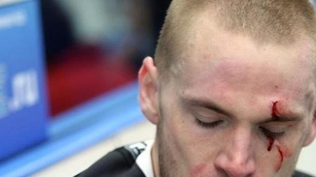 Martin Škoula po bitce s Darcym Verotem. Martin Škoula po bitce s Darcym Verotem.