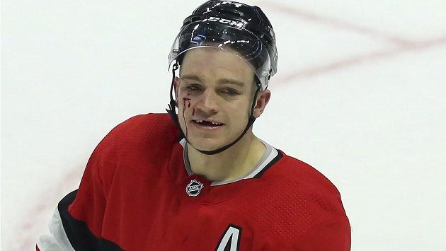 Obránce Ottawy Mark Borowiecki s tržným zraněním pod pravým okem. Obránce Ottawy Mark Borowiecki s tržným zraněním pod pravým okem.