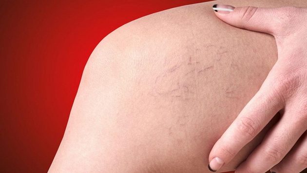 Křečové žíly mohou být problém, také esteticky nepůsobí vábně. Křečové žíly mohou být problém, také esteticky nepůsobí vábně.