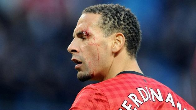 Obránci Manchesteru United Riu Ferdinandovi roztrhla obočí mince hozená z hlediště. Obránci Manchesteru United Riu Ferdinandovi roztrhla obočí mince hozená z hlediště.