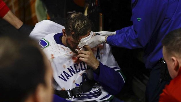 Alexander Edler z Vancouveru a jeho krvavé zranění v obličeji po neúmyslném kontaktu s Jakubem Voráčkem z Philadelphie. Alexander Edler z Vancouveru a jeho krvavé zranění v obličeji po neúmyslném kontaktu s Jakubem Voráčkem z Philadelphie.