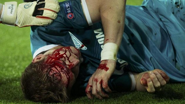 Zakrvácený slovenský stoper Tomáš Hubočan po srážce s kolenem Roberta Lewandowského. Zakrvácený slovenský stoper Tomáš Hubočan po srážce s kolenem Roberta Lewandowského.