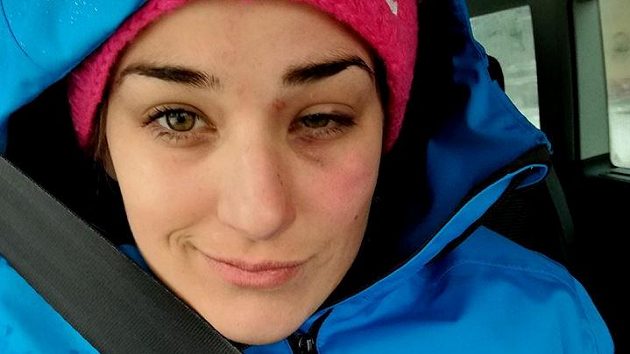 Skikrosařka Andrea Zemanová s monoklem, který utrpěla při závodě v německém Feldbergu. Skikrosařka Andrea Zemanová s monoklem, který utrpěla při závodě v německém Feldbergu.