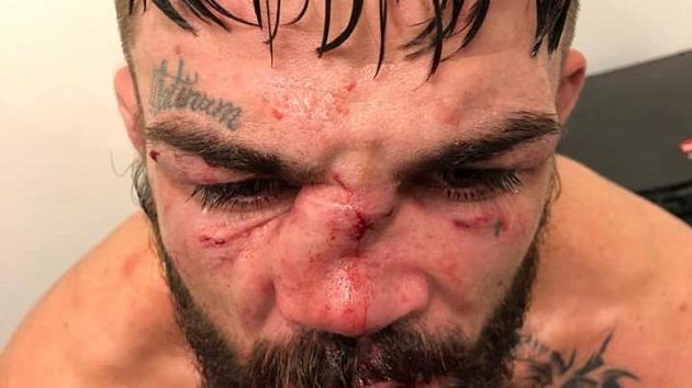 Mike Perry pár minut po zápase. Tady bude hodně práce pro lékaře. Mike Perry pár minut po zápase. Tady bude hodně práce pro lékaře.