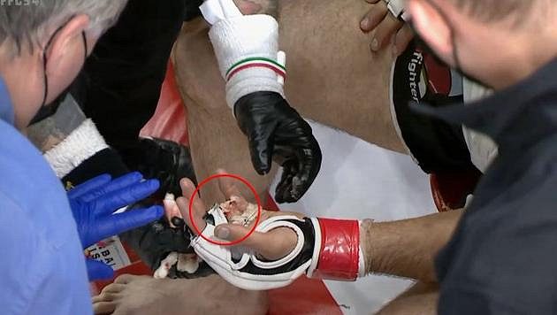 Zranění ruky zapásnika Chetaga Plieva během MMA zápasu ve Philadelphii. Zranění ruky zapásnika Chetaga Plieva během MMA zápasu ve Philadelphii.