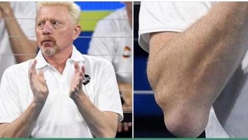 Boris Becker má dlouhodobé problémy s tenisovými lokty Boris Becker má dlouhodobé problémy s tenisovými lokty